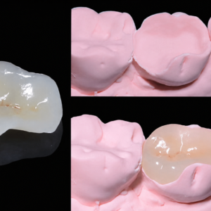 All-Ceramic Inlays