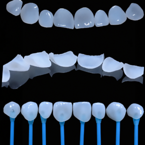 All-Ceramic Veneers