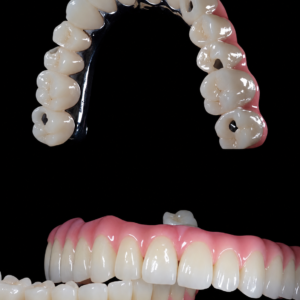 Implant-Retained Complete Dentures